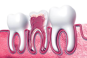 root canal image in fort smith ar