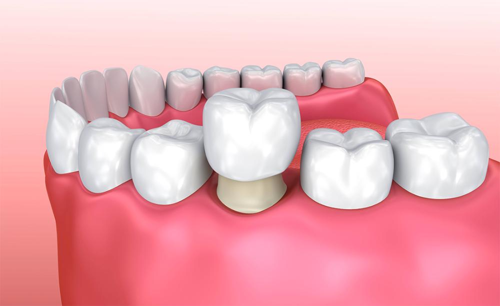 dental crown in fort smith ar